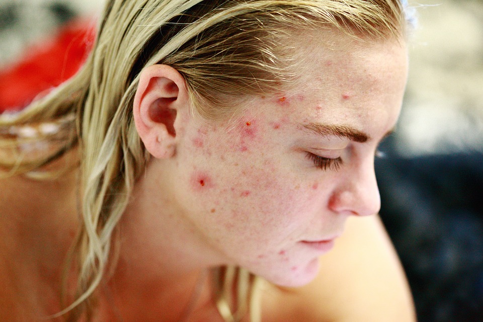 woman with pimples